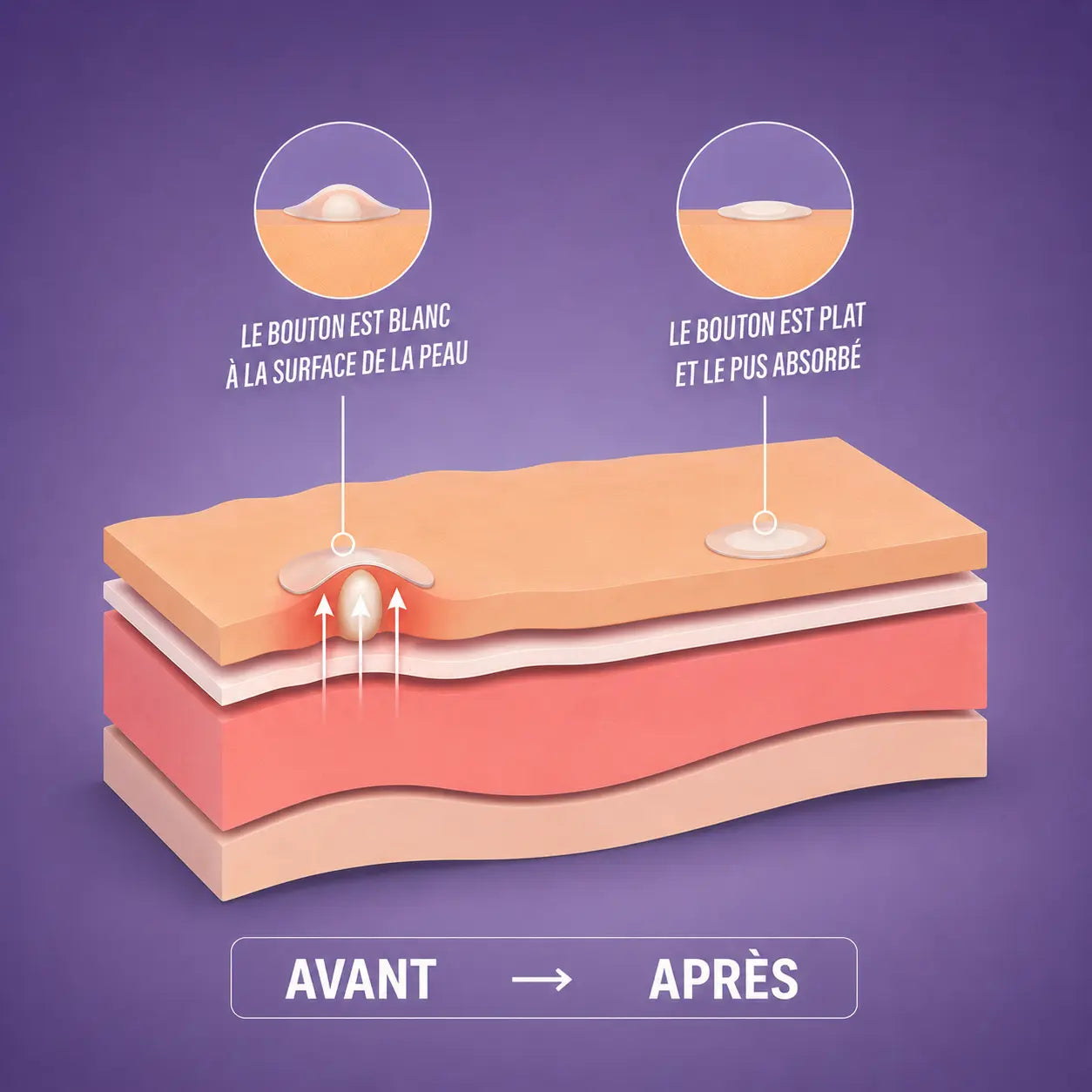 Patchs anti-acné